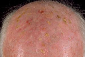 Solar keratosis deals