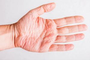 atopic dermatitis palms