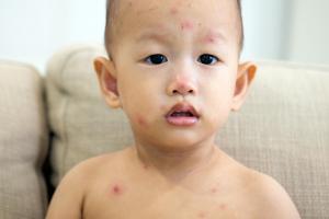 chicken pox rash pictures early stages