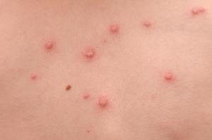 Skin rashes in children