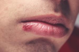 mild herpes lips