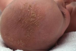 Skin rashes in babies