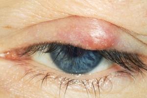 Stye on the Eyelid: Causes, Treatment, and More