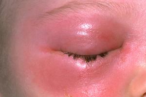 upper eyelid infection