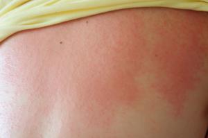 Heat Rash in Adults Treatments