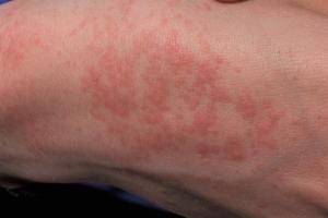 mild heat rash legs