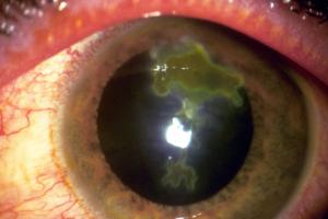 herpes simplex under eye