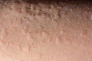 hives on black people skin
