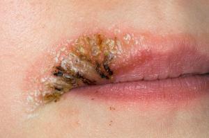 Picture showing impetigo on a lip