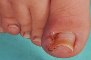 Reasons an Ingrown Toenail May Develop