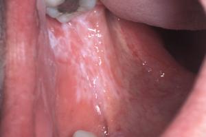 oral lichen planus cheek