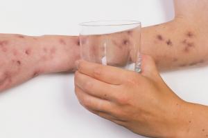 Child's arm with a blotchy rash that doesn't fade when a glass is rolled over