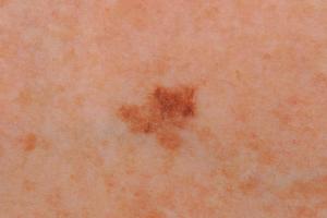 moles that change color