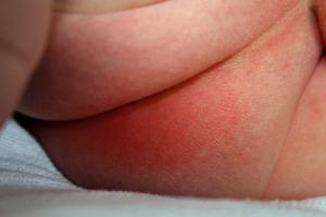 Skin rashes in babies