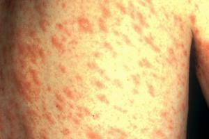 15 Common Skin Rashes in Children: Types and Causes