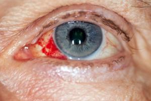 enlarged blood vessel in eye