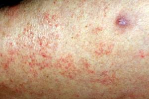 scabies burrows on legs