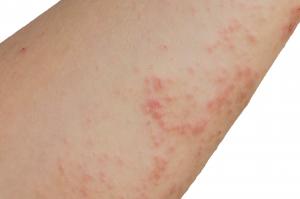 Rashes in babies and children - NHS