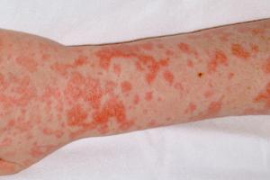 Sand paper' rash in scarlet fever