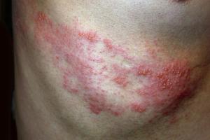 shingles rash on face