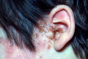 mild shingles on face