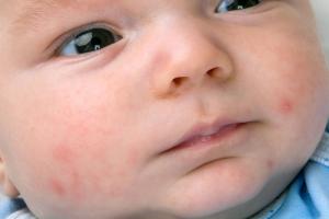 baby dry skin rash