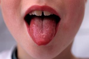 Red White Spot Under Tonguechild Infected Stock Photo 1077529199
