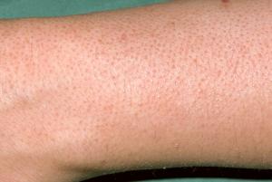 Skin rashes in children