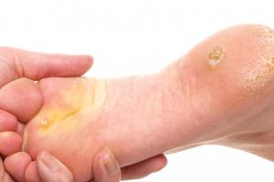 Corn and Callus Prevention - Walk This Way Healthcare