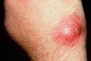 Boils on Inner Thigh: Identification, Treatment, and More