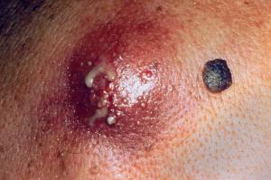 Armpit boil (furuncle): Causes, Symptoms, Treatment and Cost