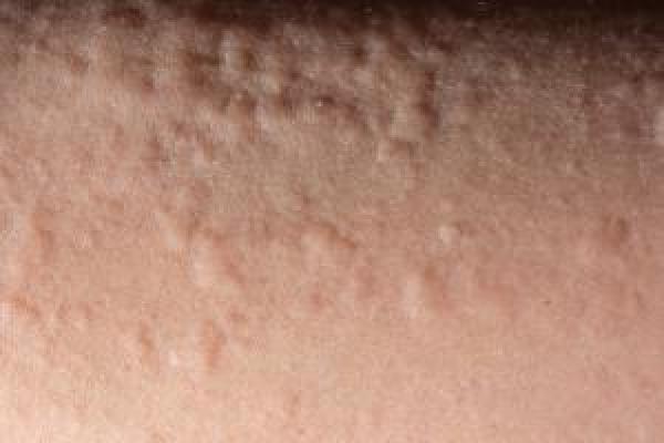 Urticaria (hives) | Nidirect