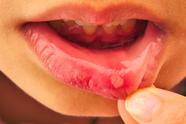 mouth-ulcers-and-cold-sores-what-s-the-difference