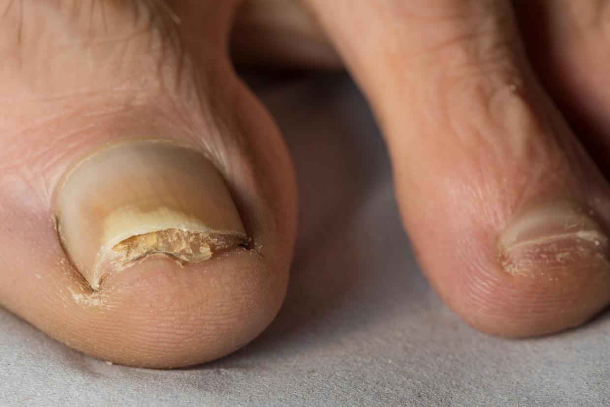 Fungal Nail Infection | Nidirect