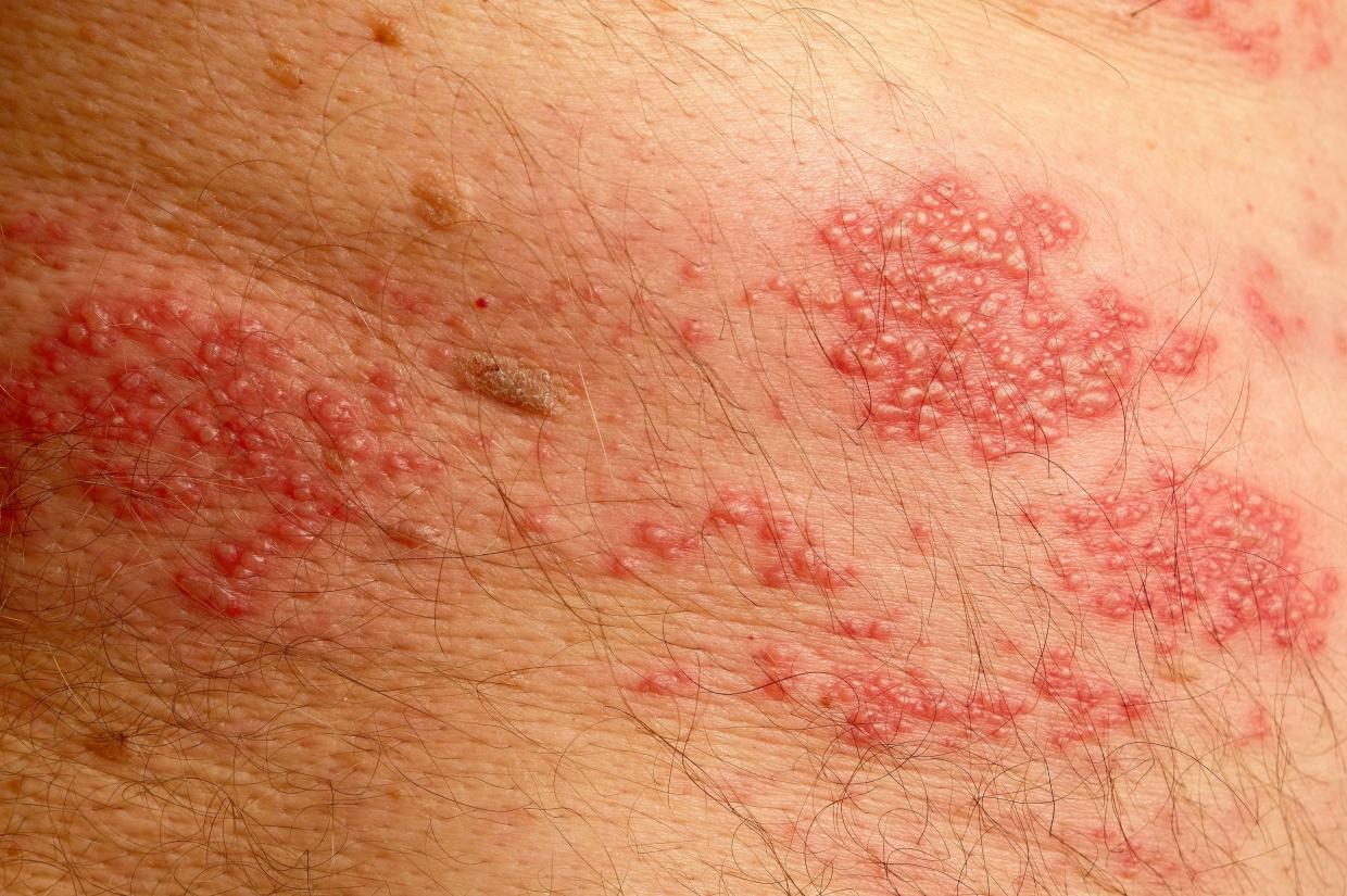 Shingles | Nidirect