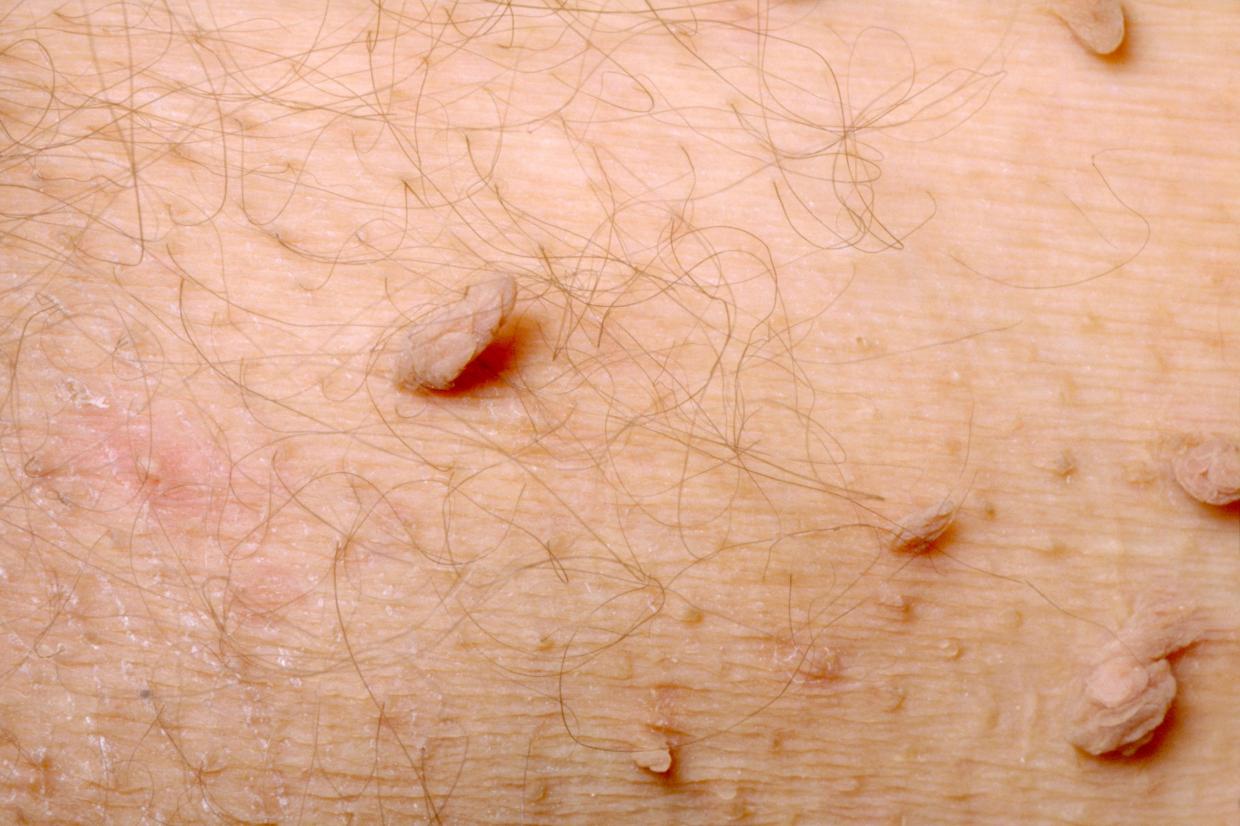 pictures of skin tags in armpit