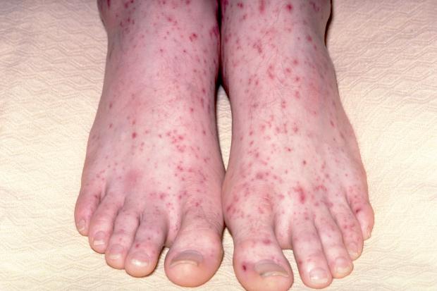 Meningitis rash on feet Picture of meningitis rash on feet