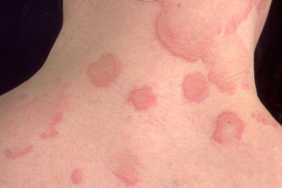 Urticaria (hives) | Nidirect