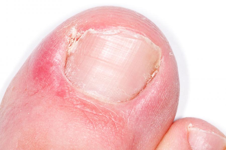 Ingrown Toenail Nidirect