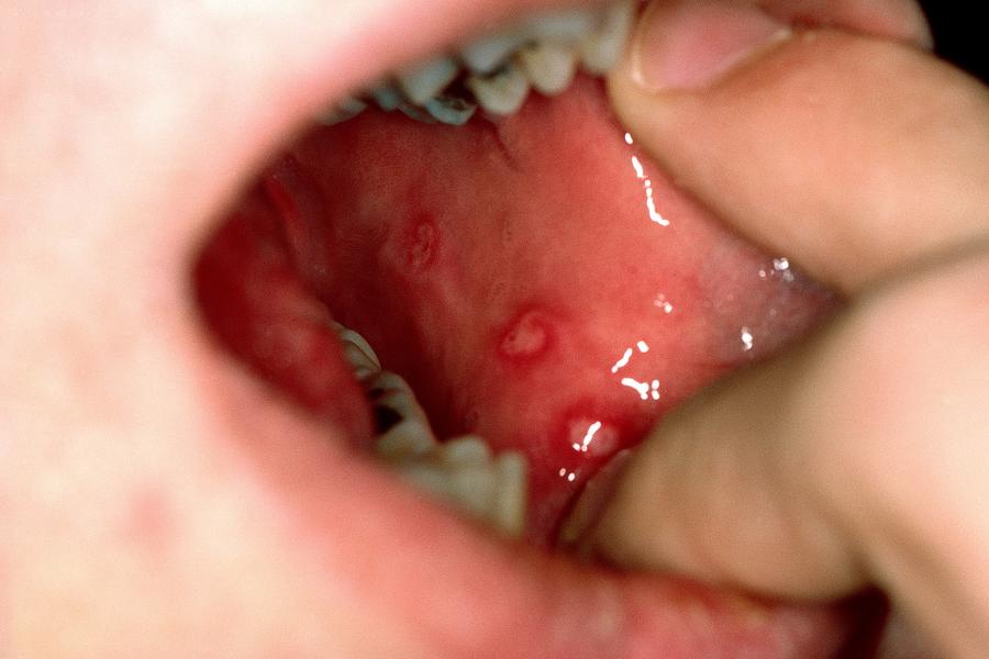Mouth ulcers nidirect